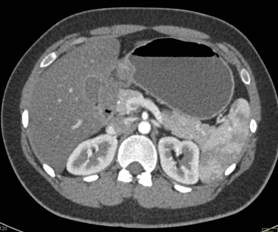 2 cm Gastric GIST Tumor - CTisus CT Scan