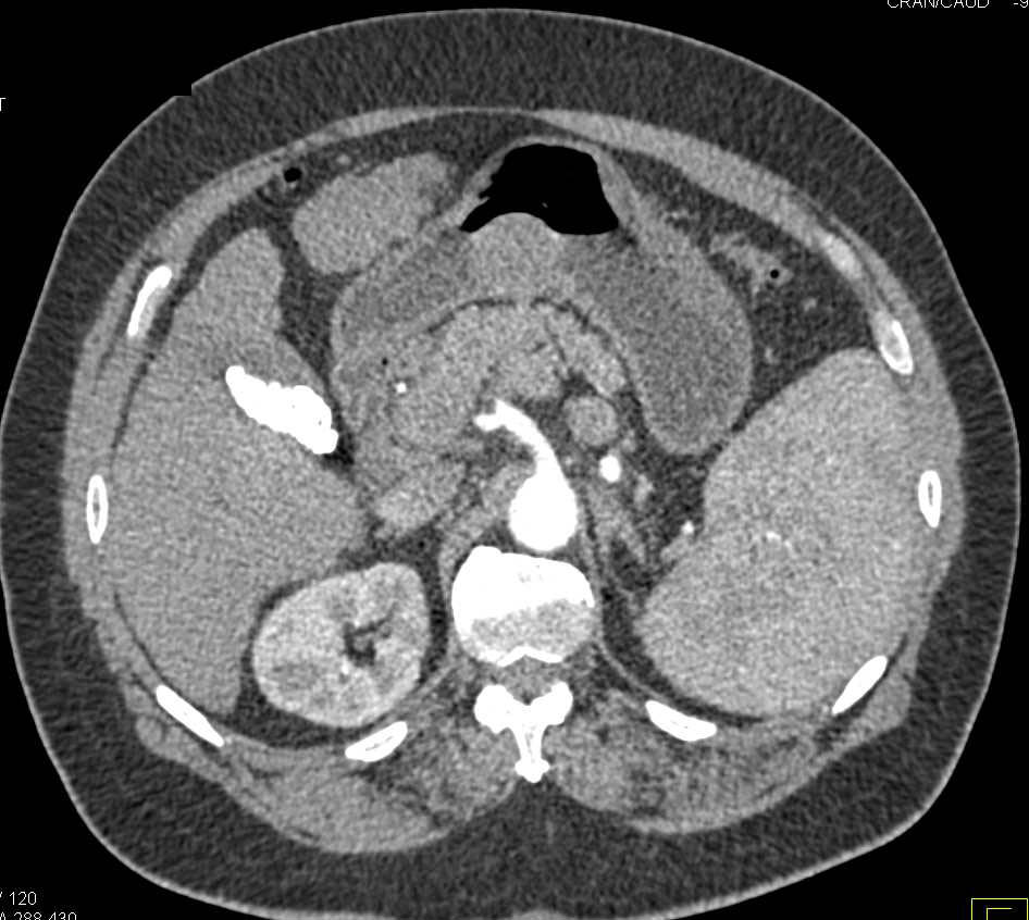 2 cm Gastric GIST Tumor in Cirrhotic Patient - CTisus CT Scan