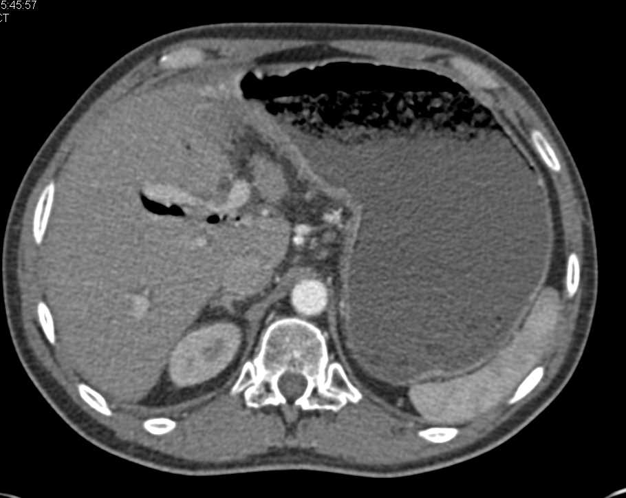 Gastric Outlet Obstruction due to Pancreatic Cancer Invading the Duodenum - CTisus CT Scan