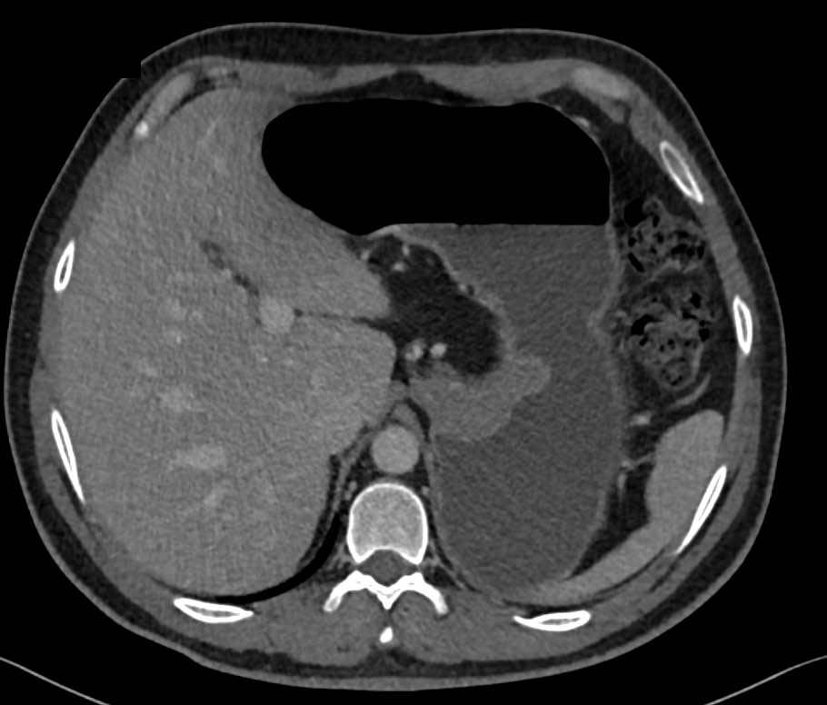 Incidental Gastric GIST Tumor - CTisus CT Scan