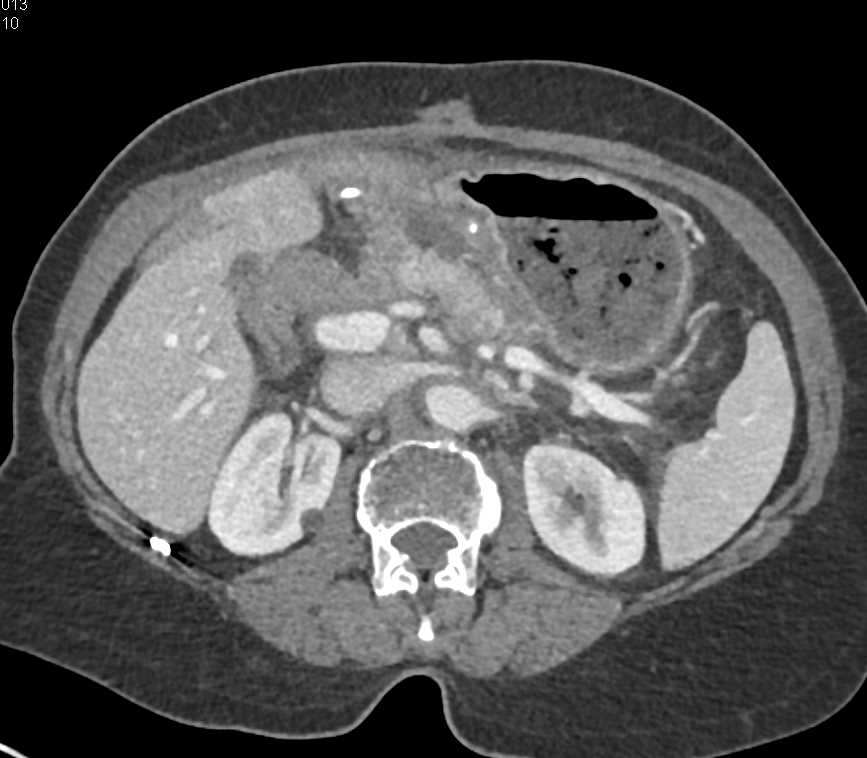 Infiltrating Gastric Cancer Involves Antrum with Local Inflammation - CTisus CT Scan