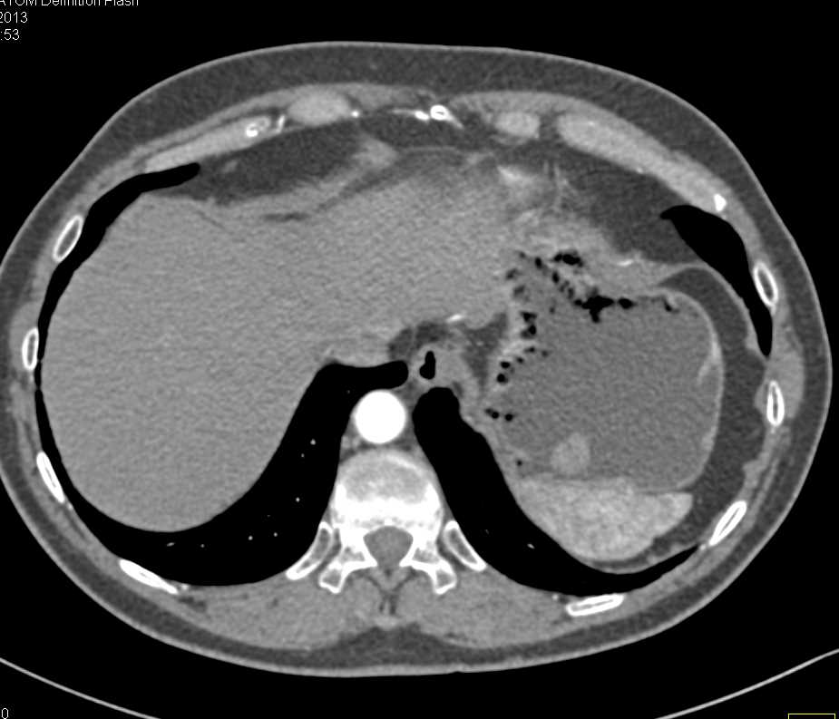 Small Gastric GIST Tumor - CTisus CT Scan