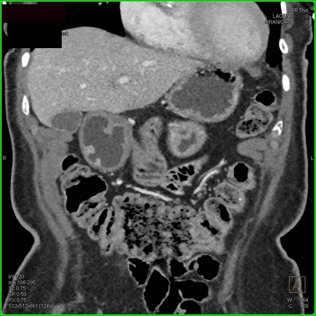 Hyperplastic Antral Polyps - CTisus CT Scan