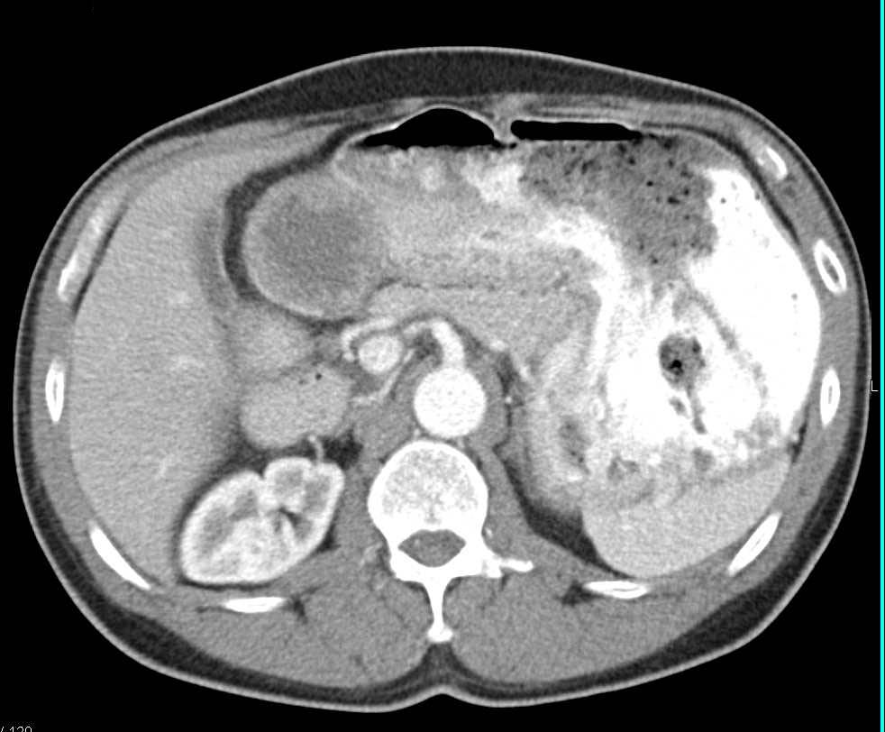 GIST Tumor and Gastric Outlet Obstruction - CTisus CT Scan