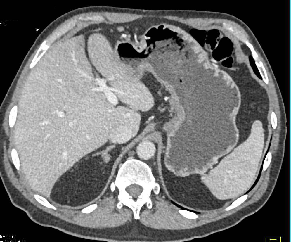 Subtle Gastric Adenocarcinoma - CTisus CT Scan