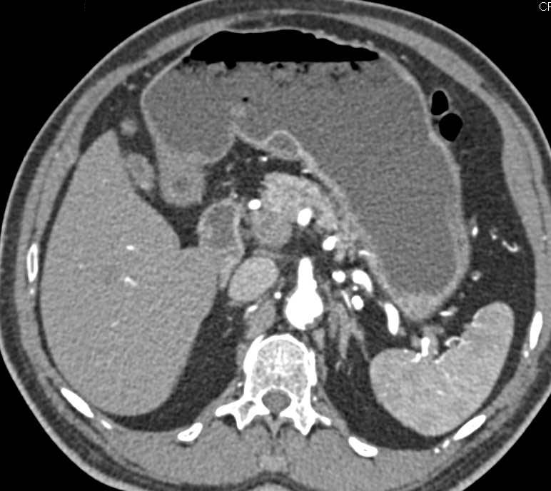 Incidental 1cm GIST Tumor in the Stomach - CTisus CT Scan