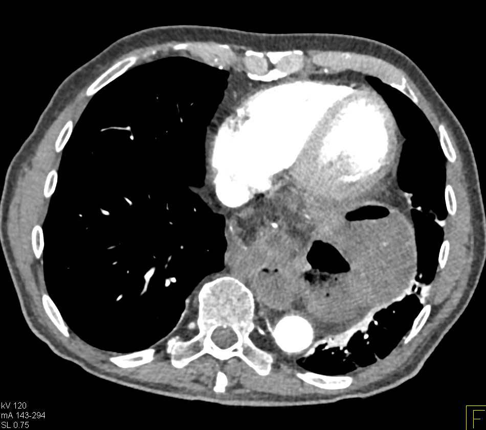 Gastric Volvulus and Pelvic Abscess - CTisus CT Scan