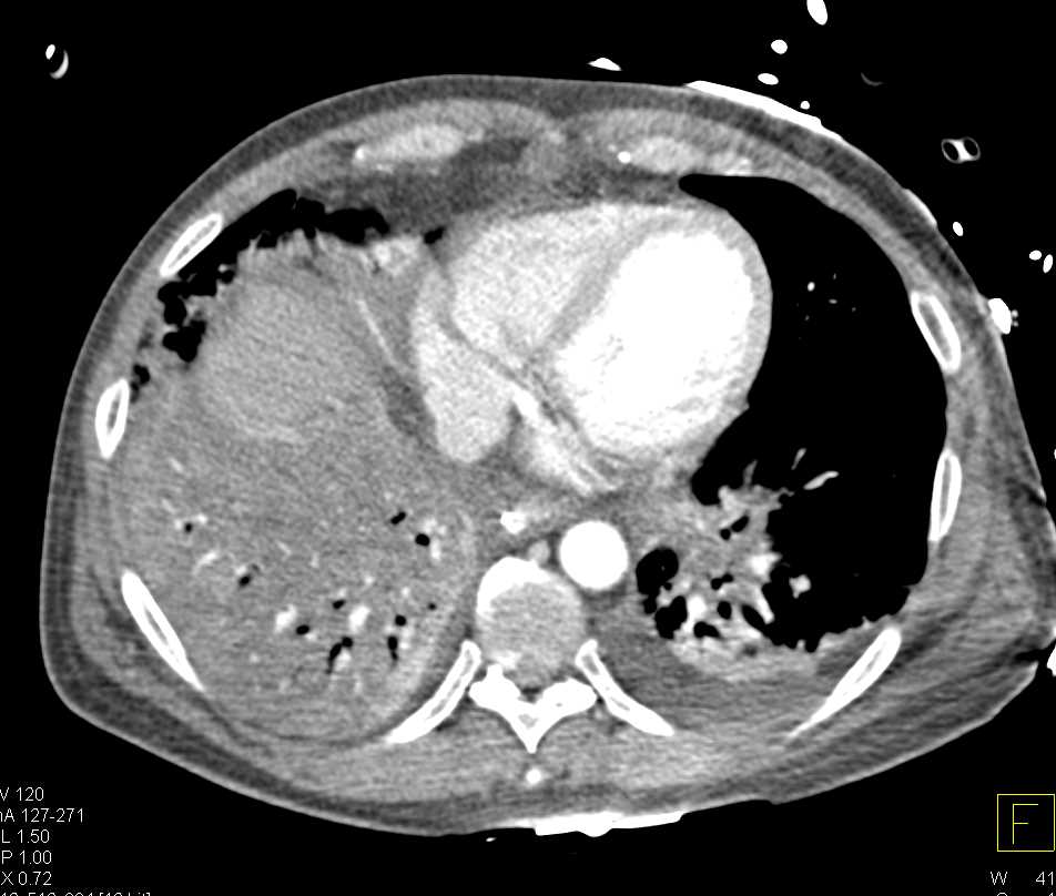 G-Tube Outside of Stomach with Free Contrast in Abdominal Cavity - CTisus CT Scan