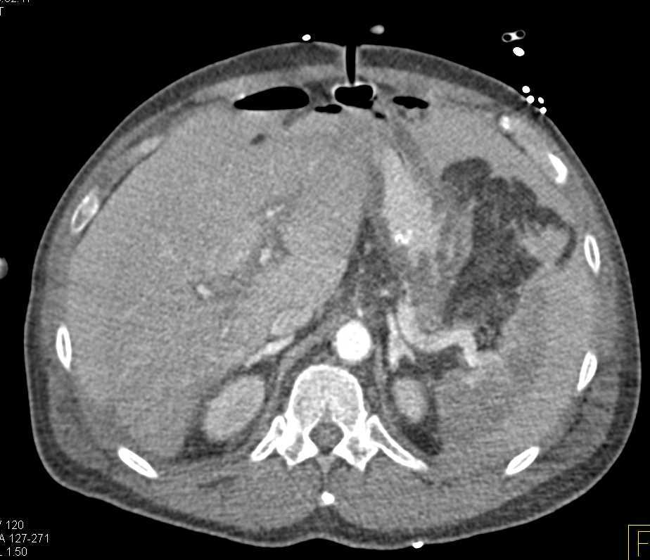 G-Tube Outside of Stomach with Free Contrast in Abdominal Cavity - CTisus CT Scan