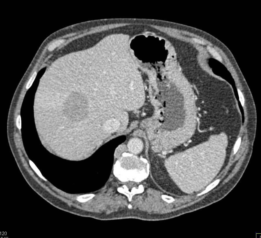 Gastric Cancer with Extensive Adenopathy - Stomach Case Studies ...