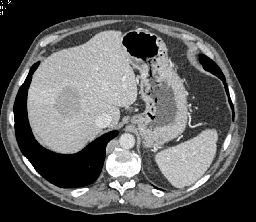 Gastric Cancer with Extensive Adenopathy - CTisus CT Scan