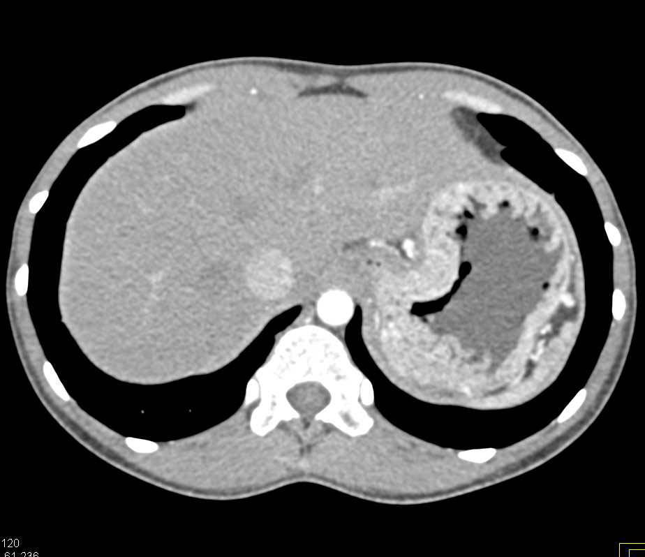 Thickened Gastric Folds from Zollinger-Ellison Syndrome - CTisus CT Scan