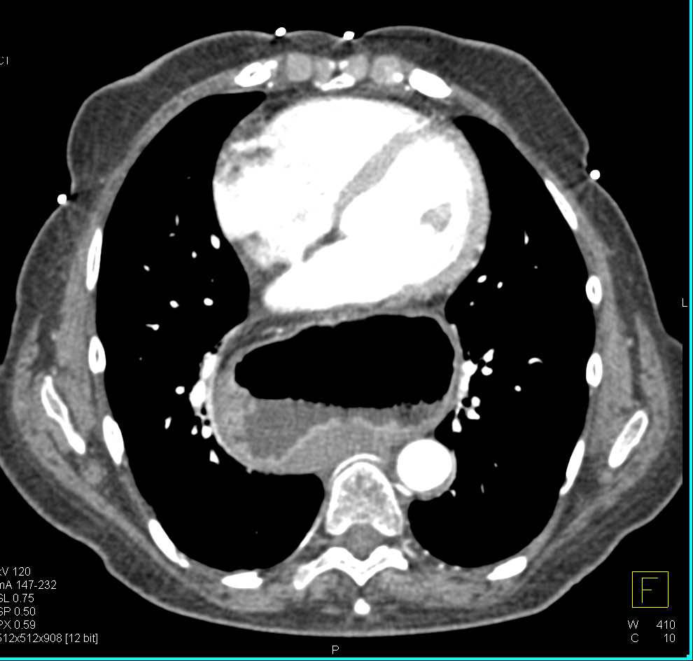 Gastric Volvulus - CTisus CT Scan