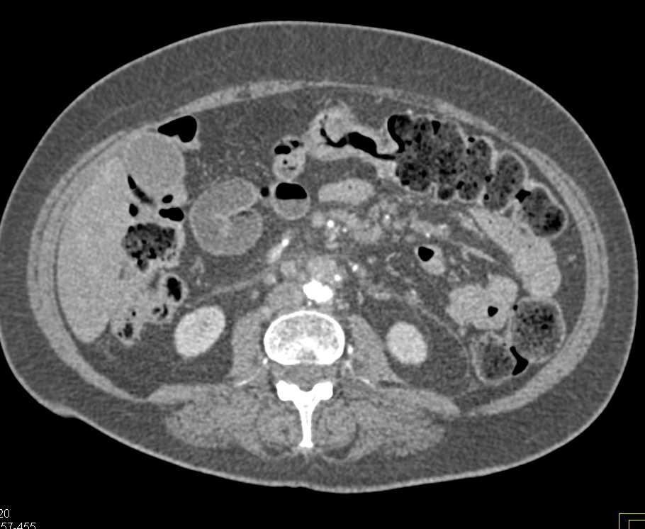 Antral Carcinoma - CTisus CT Scan