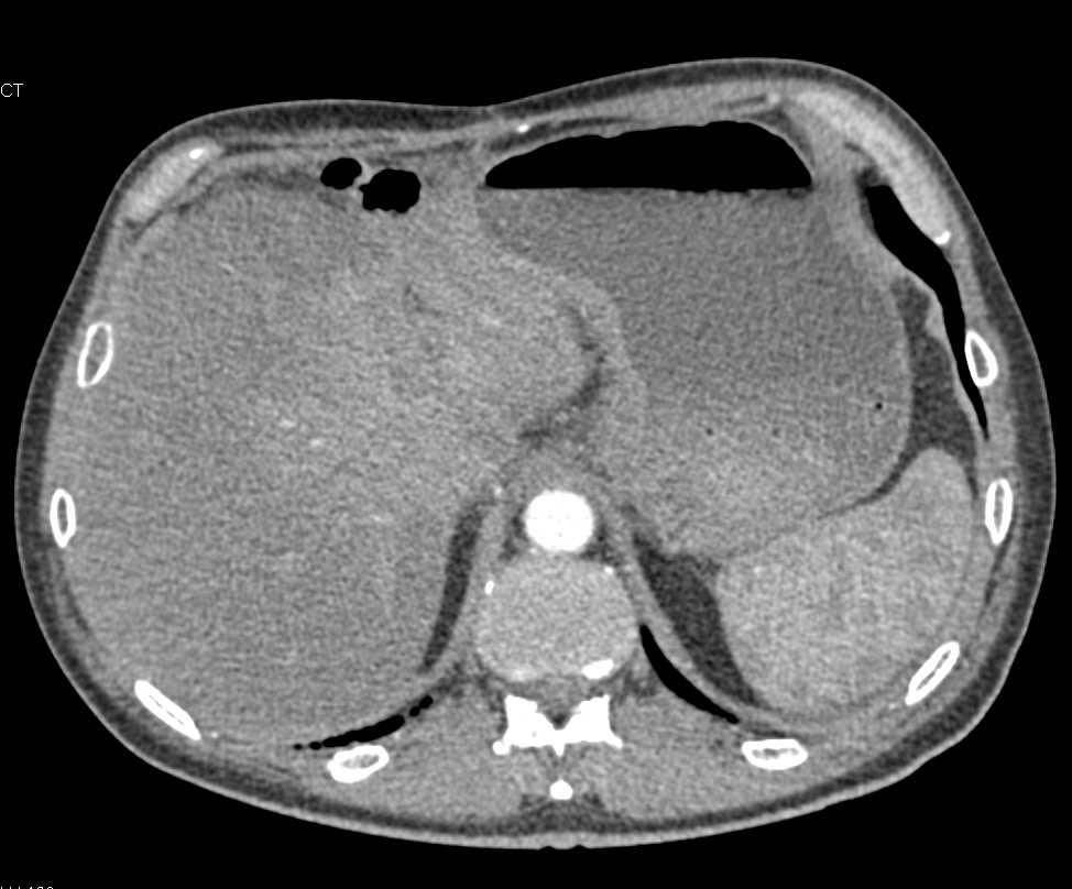 Antral Carcinoma of the Stomach - CTisus CT Scan