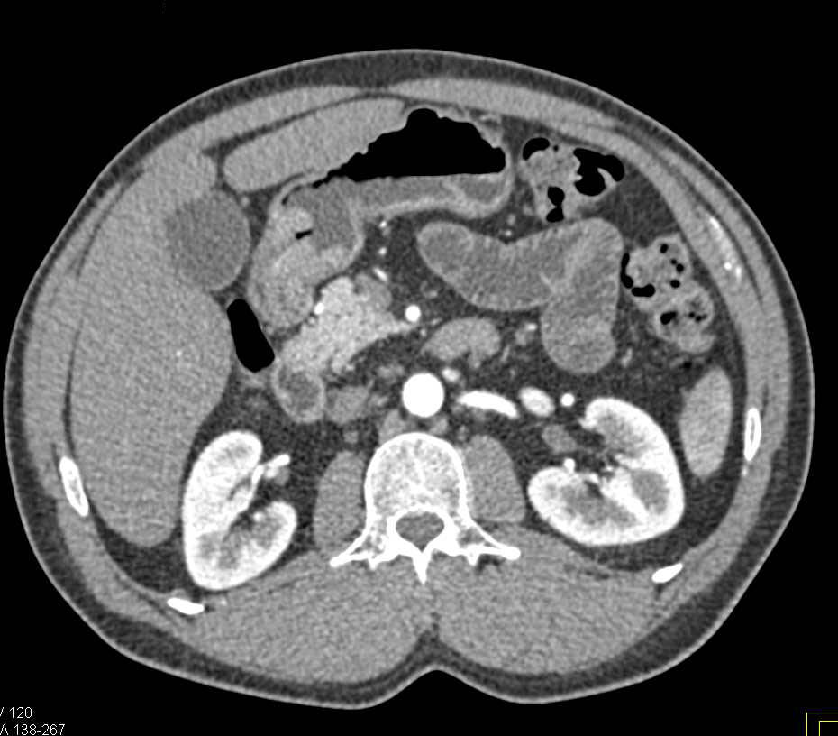 Carcinoma in the Gastric Antrum - CTisus CT Scan