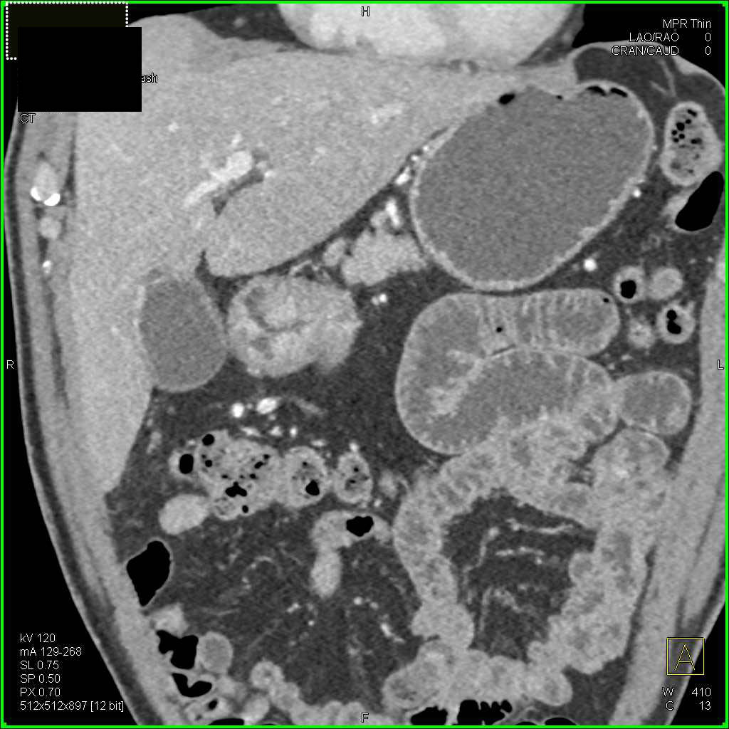 Adenocarcinoma in the Gastric Antrum - CTisus CT Scan