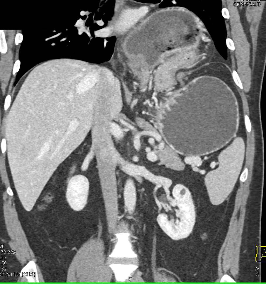 paraesophageal hernia with gastric volvulus