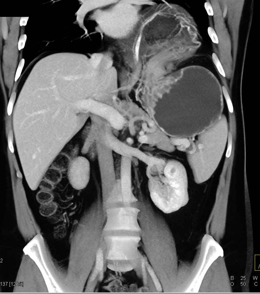 Large Hiatal Hernia with Gastric Volvulus - CTisus CT Scan