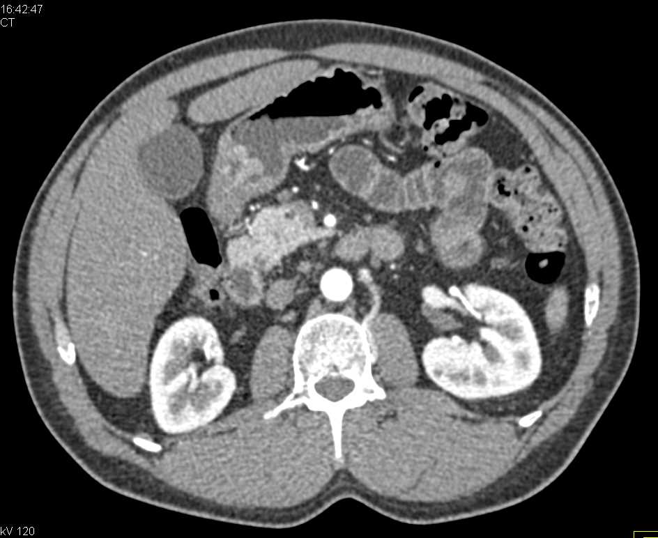 Carcinoma of the Antrum of the Stomach - CTisus CT Scan