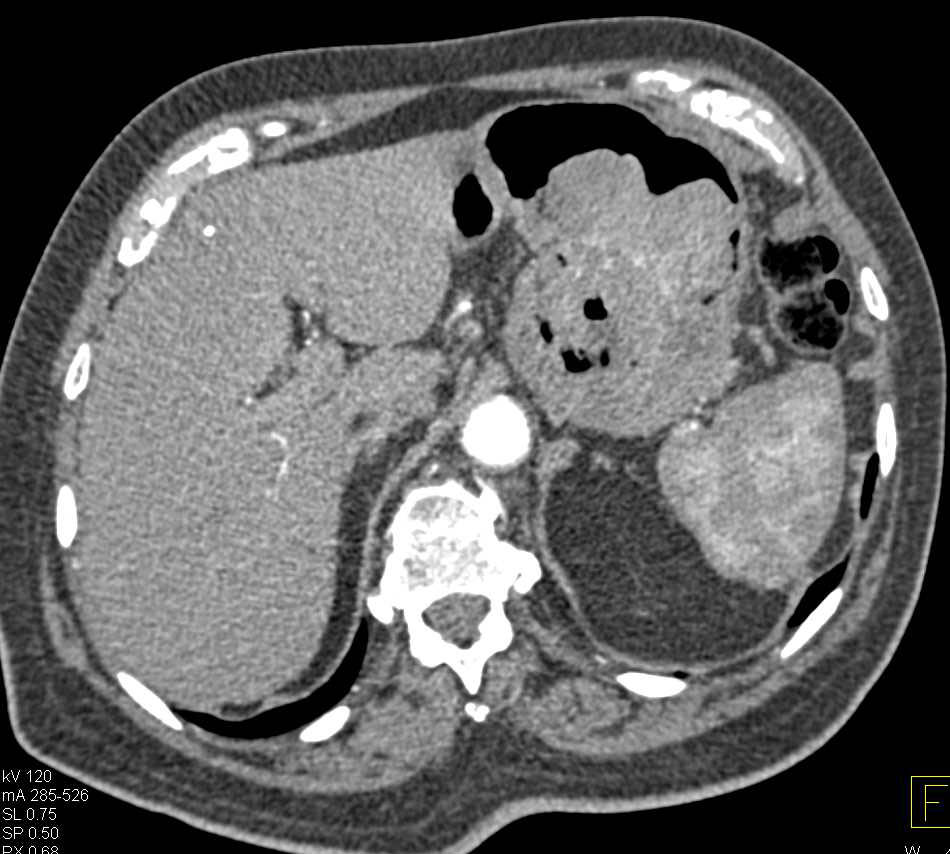 Ulcerating Gastric GIST Tumor - CTisus CT Scan