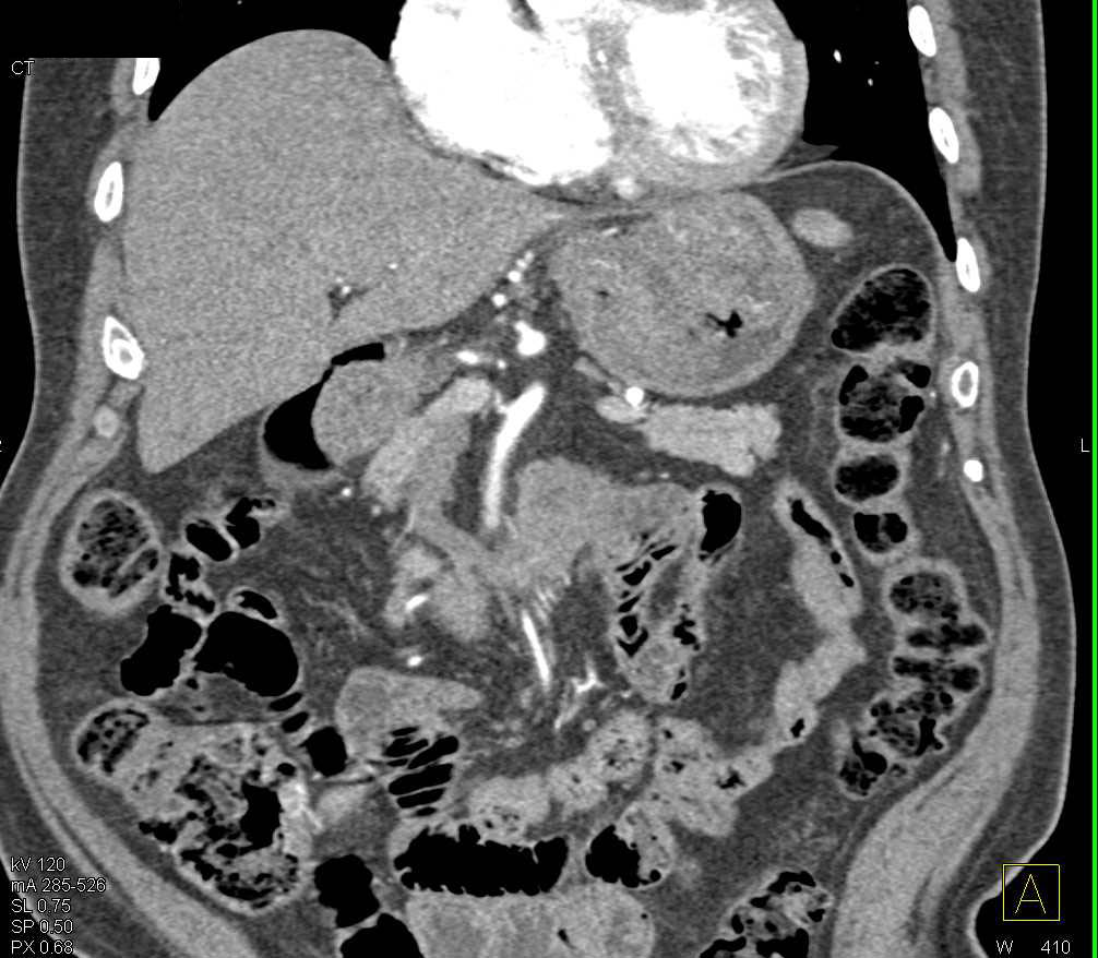 Bulky Adenocarcinoma of the Gastric Fundus with Ulcerations - CTisus CT Scan