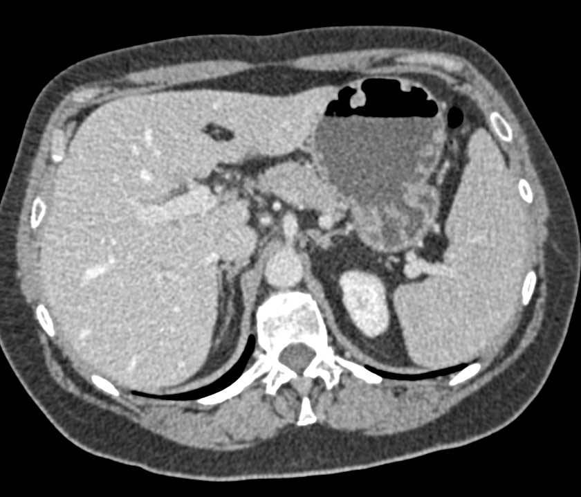 Gastric Polyps in Tuberous Sclerosis - CTisus CT Scan