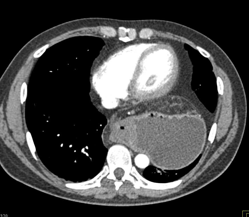 Large Hernia with Gastric Volvulus - CTisus CT Scan