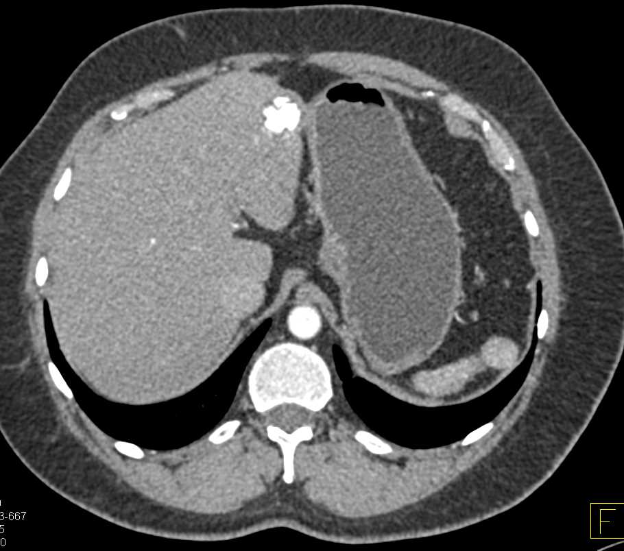 Gastric Lipoma and Calcified Hemangioma in Left Lobe of the Liver - CTisus CT Scan