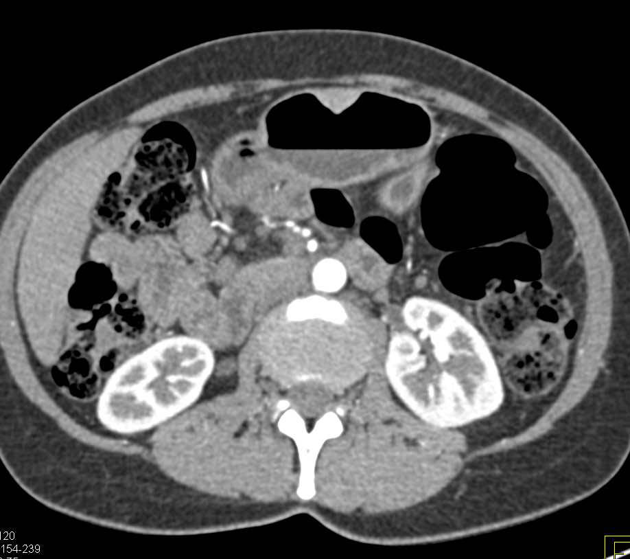 GIST Tumor Anterior Gastric Wall in 3D - CTisus CT Scan