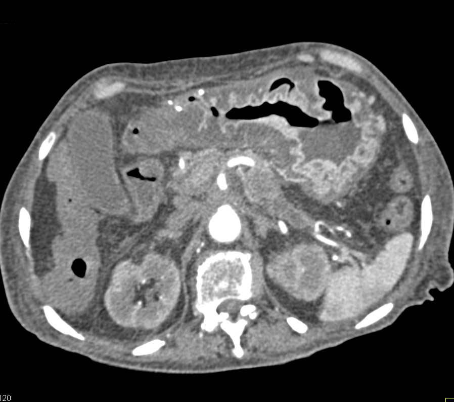 Severe Gastritis in Patient with Pancreatic Cancer - CTisus CT Scan