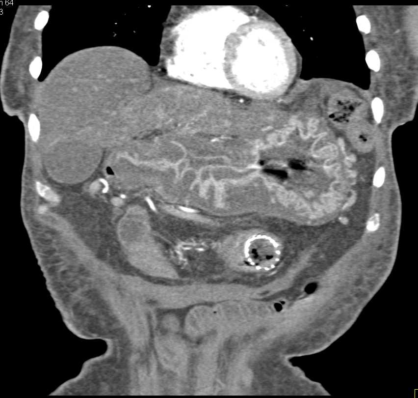 Severe Gastritis in Patient with Pancreatic Cancer - CTisus CT Scan