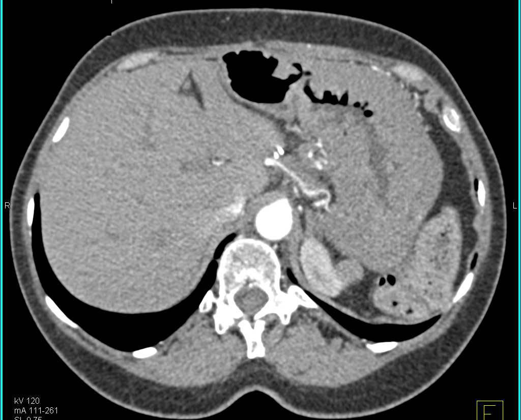 Zollinger-Ellison Syndrome with Thickened Stomach - CTisus CT Scan