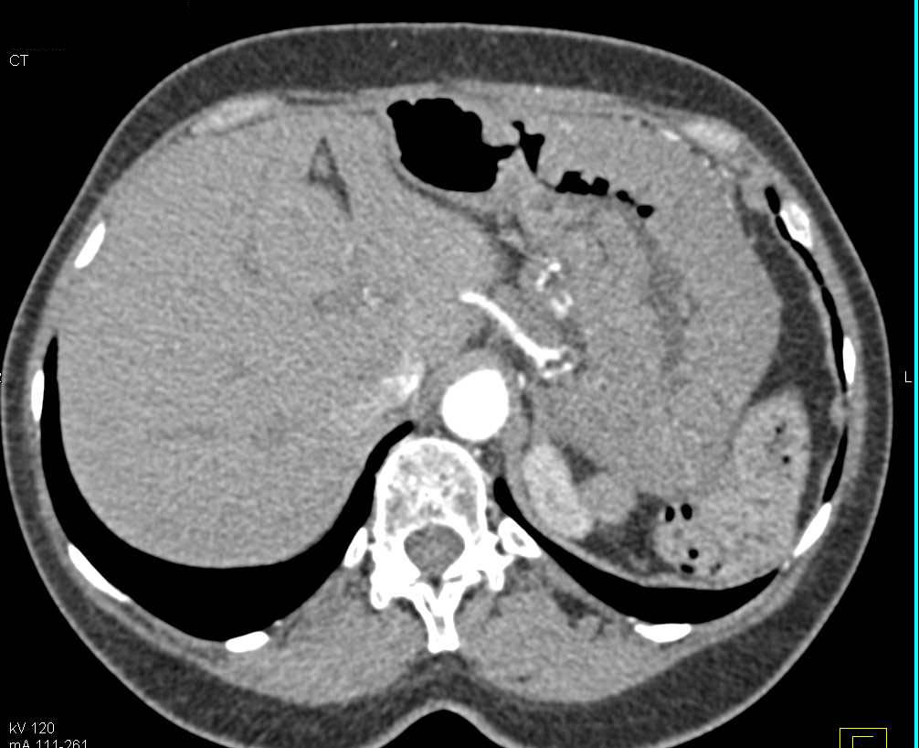 Zollinger-Ellison Syndrome with Thickened Stomach - CTisus CT Scan