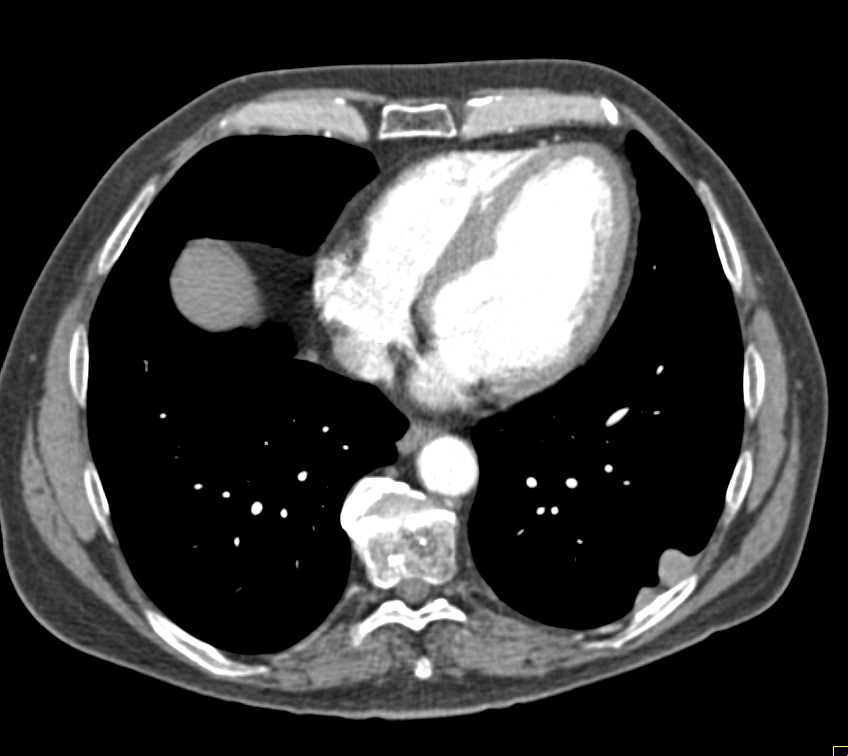 Renal Cell Carcinoma Metastatic to the Stomach, Pleural Surface and Spleen - CTisus CT Scan