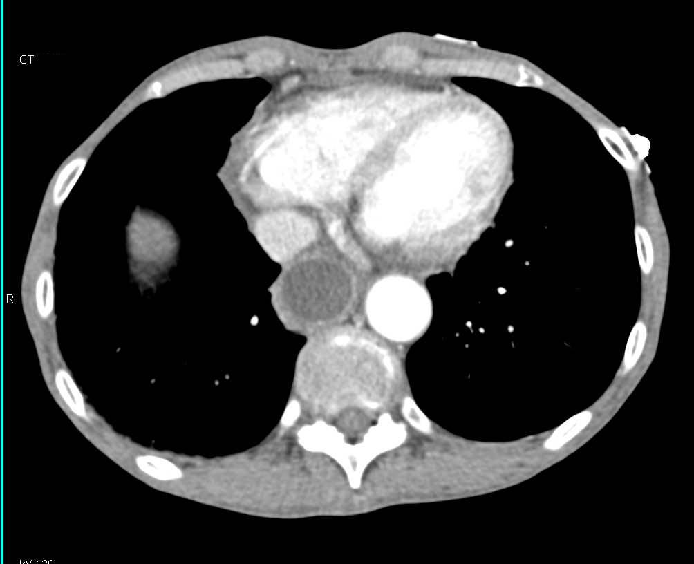 Gastric Outlet Obstruction - CTisus CT Scan