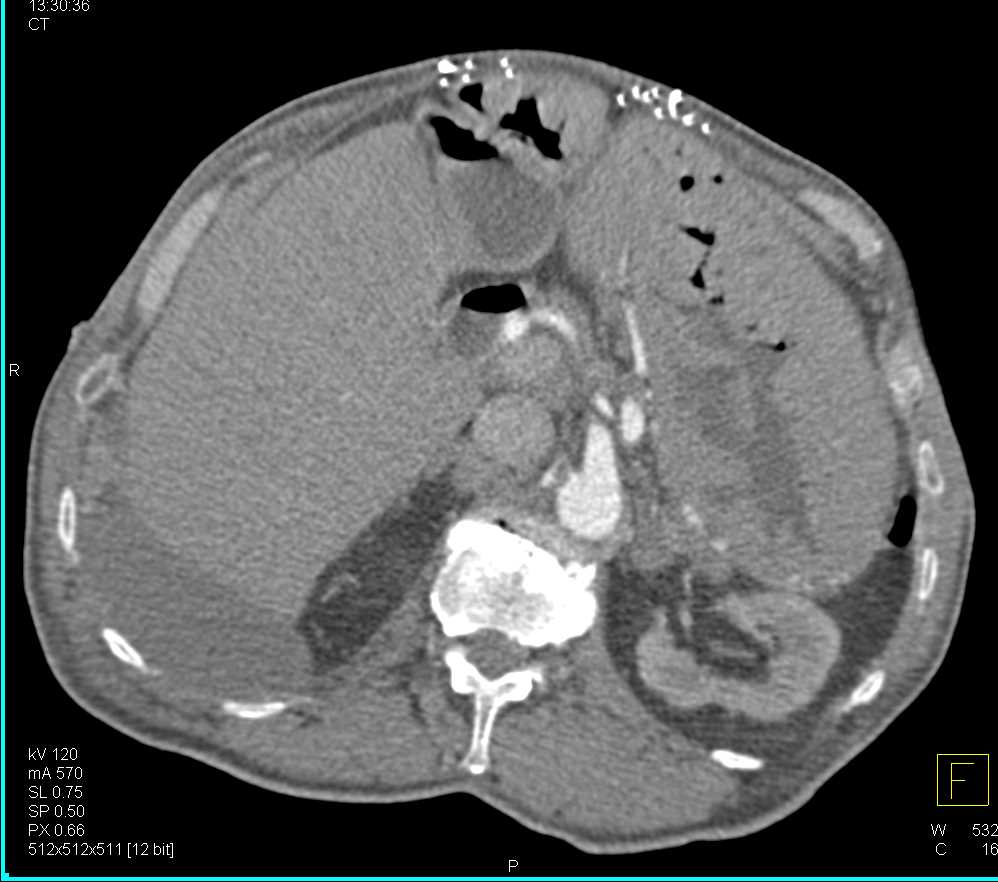 Zollinger-Ellison Syndrome with Thickened Stomach and Adenopathy - CTisus CT Scan