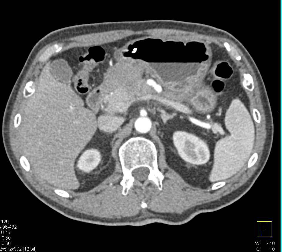 Antral Carcinoma with Stent Then Placed in Antrum - CTisus CT Scan