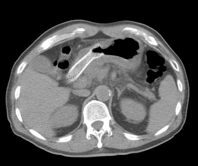 Antral Carcinoma with Stent  in Antrum and Positive PET Scan - CTisus CT Scan