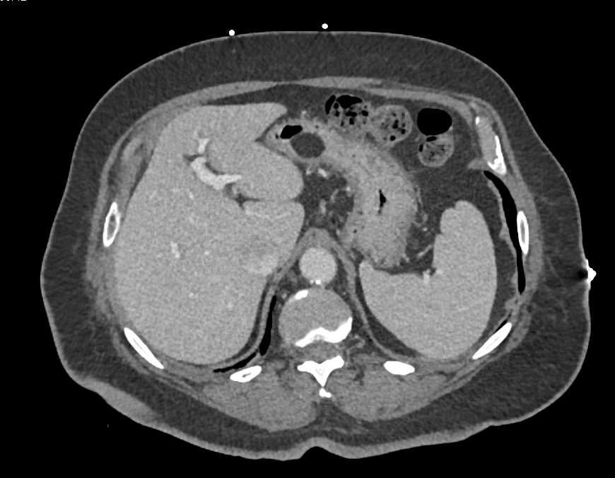 Gastric Lipoma - Stomach Case Studies - CTisus CT Scanning