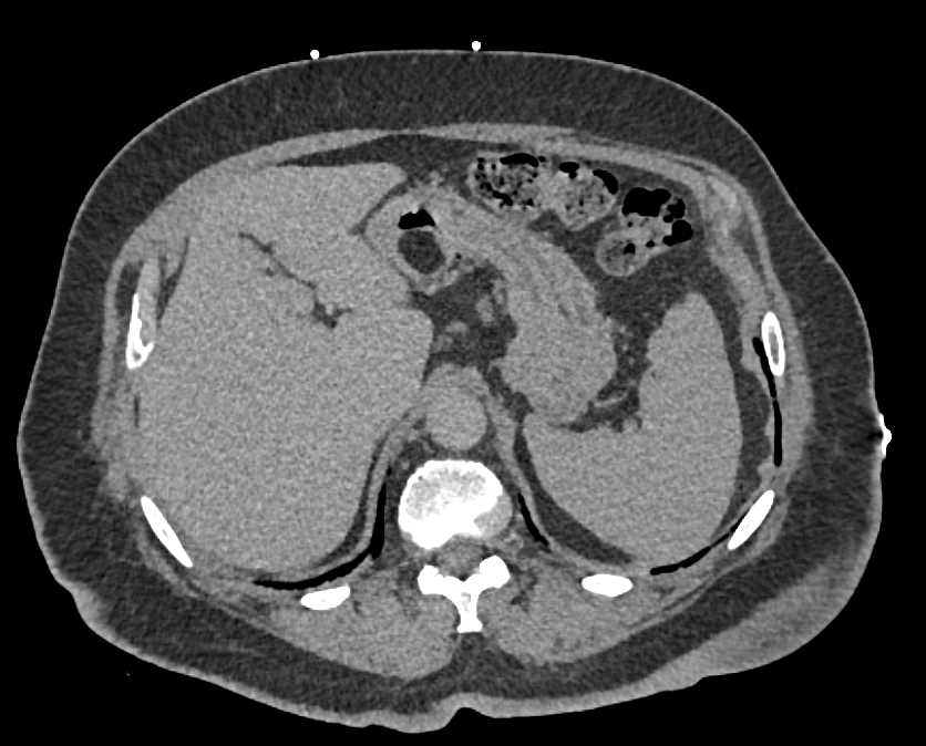 Gastric Lipoma - CTisus CT Scan