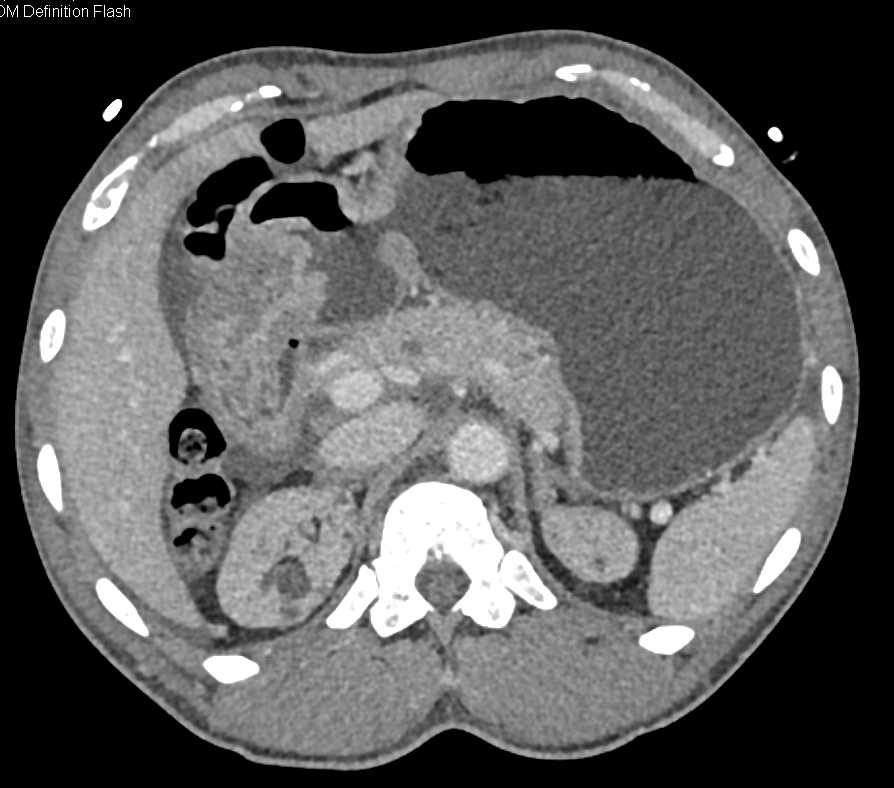 Juvenile Gastric Polyposis Infiltrates Gastric Antrum - CTisus CT Scan