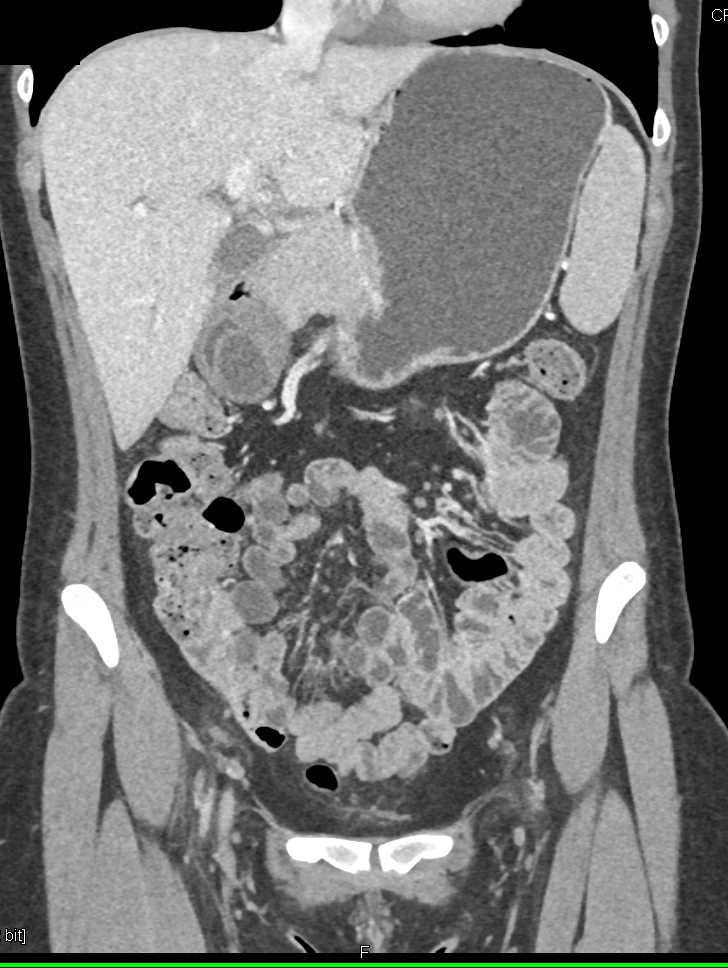 Duplication Cyst in the Gastric Antrum - CTisus CT Scan