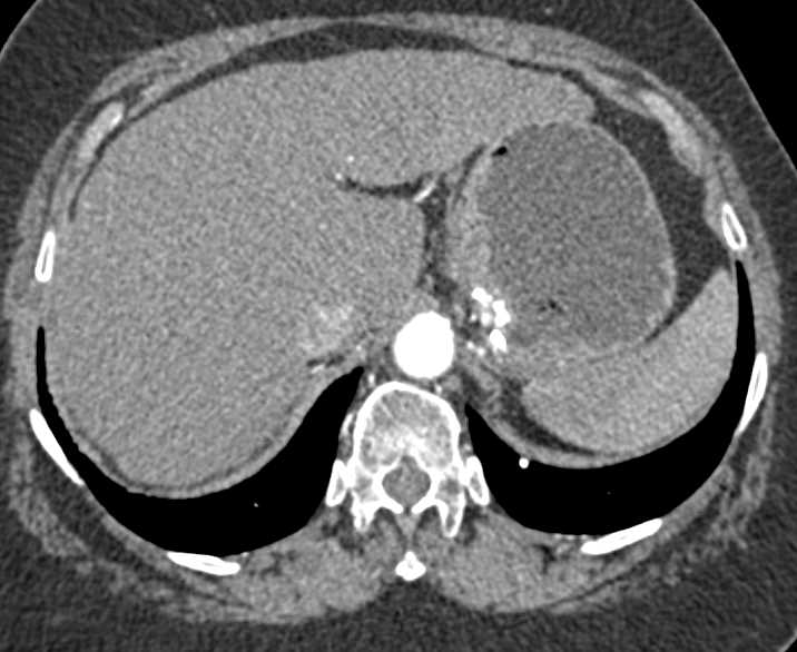 Mucinous Adenocarcinoma of the Gastric Fundus with Calcifications - CTisus CT Scan