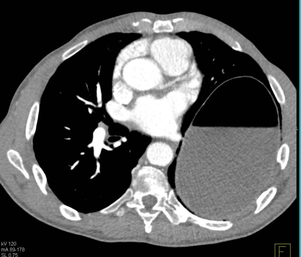 Gastric Volvulus - CTisus CT Scan