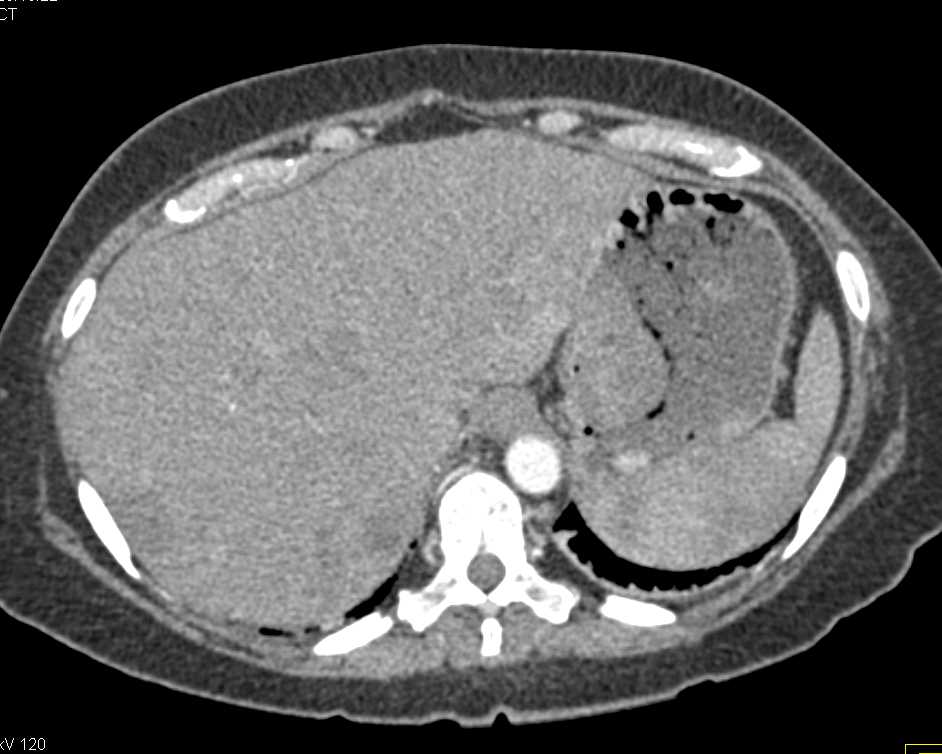 Gastric Adenocarcinoma with Liver Metastases - CTisus CT Scan