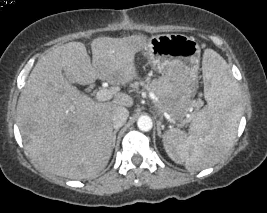 Gastric Adenocarcinoma with Liver Metastases - CTisus CT Scan