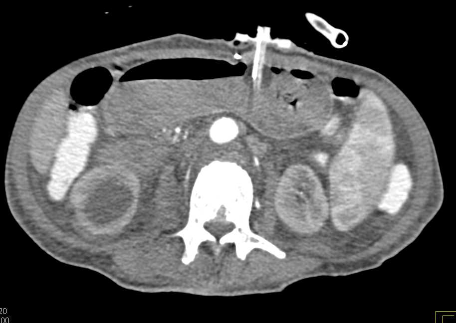 G-Tube Placement and Pneumoperitoneum - CTisus CT Scan