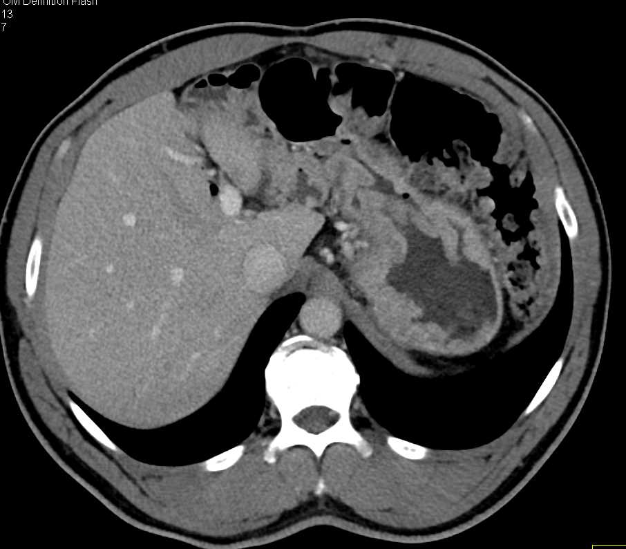 Thickened Gastric Folds with Zollinger-Ellison Syndrome - CTisus CT Scan