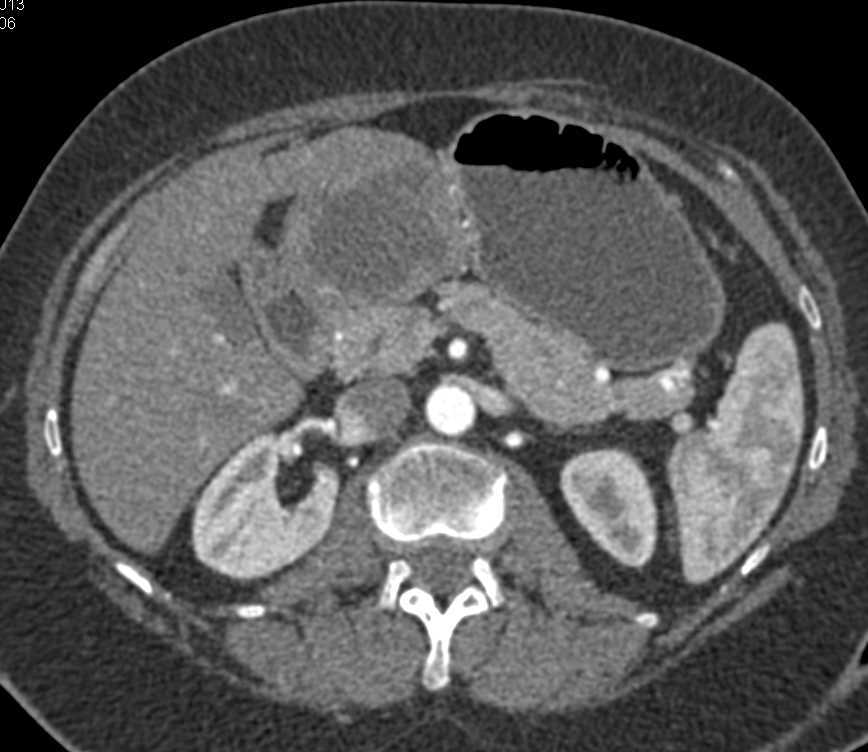 Gastric GIST Tumor - CTisus CT Scan